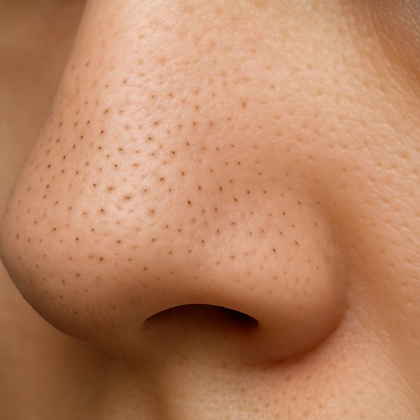 Blackheads / Whiteheads