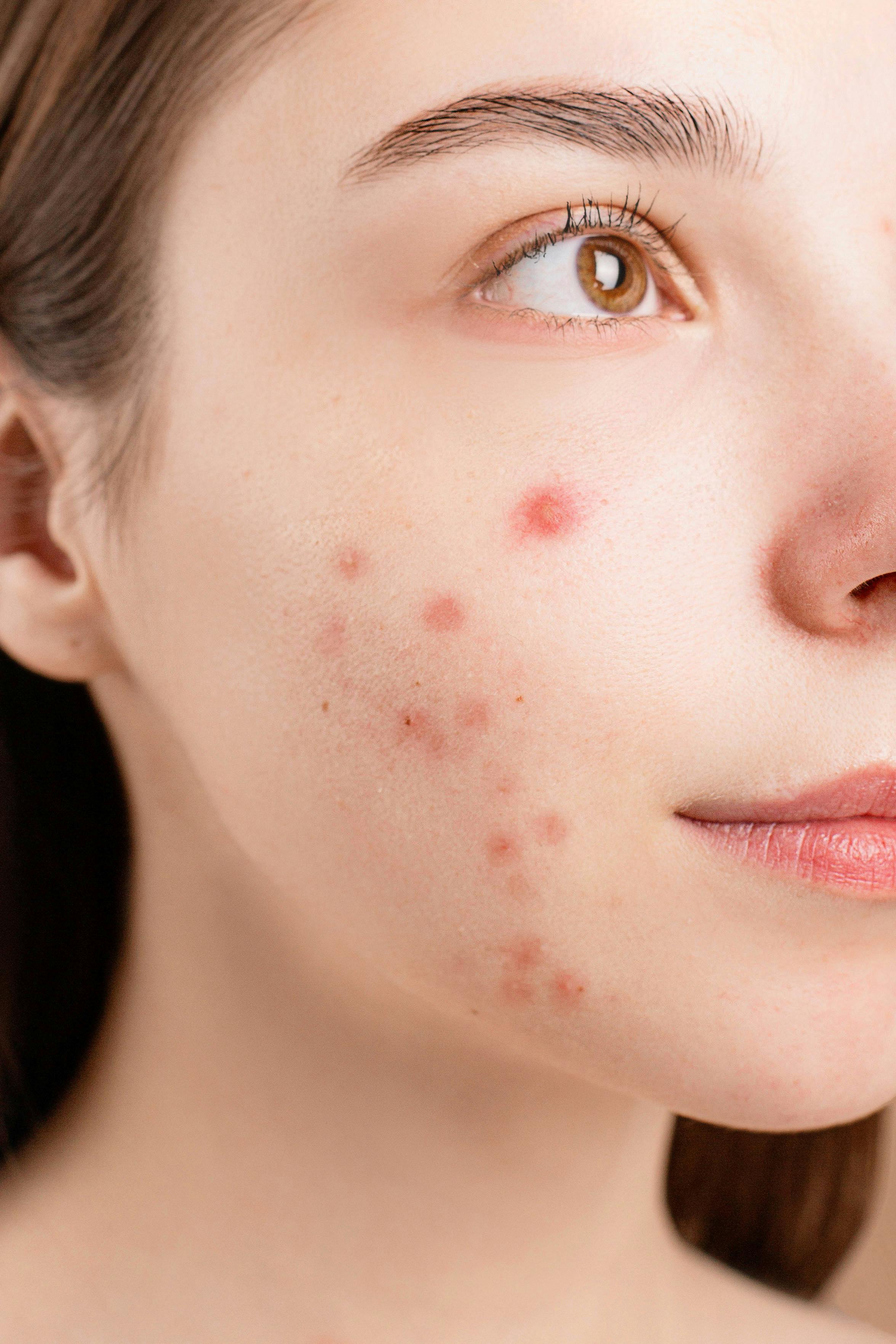 Cystic Acne