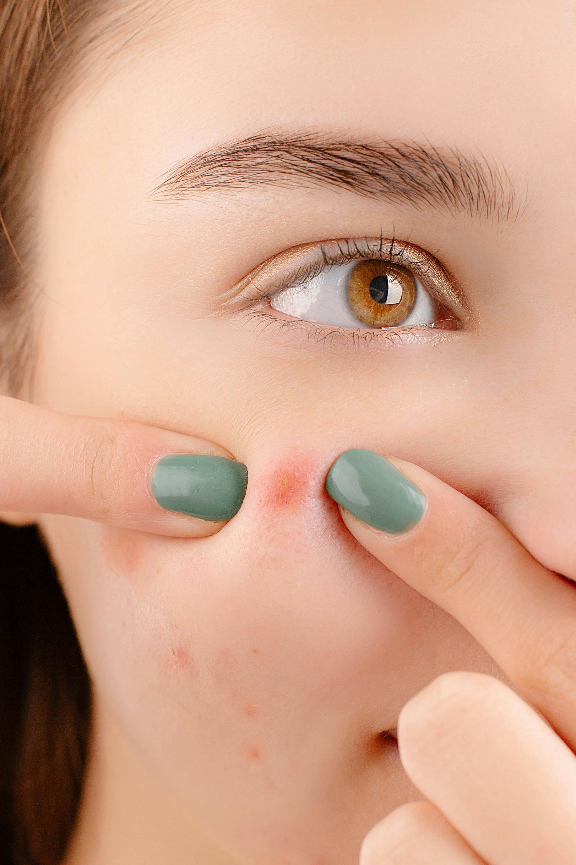 Inflammatory Acne