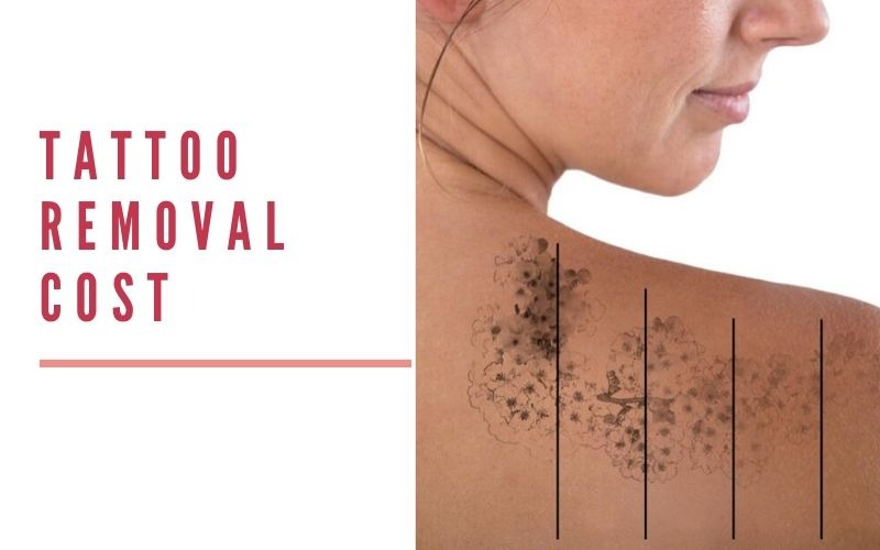1 Hour Laser Tattoo Removal Nagpur 18 To 50 Years