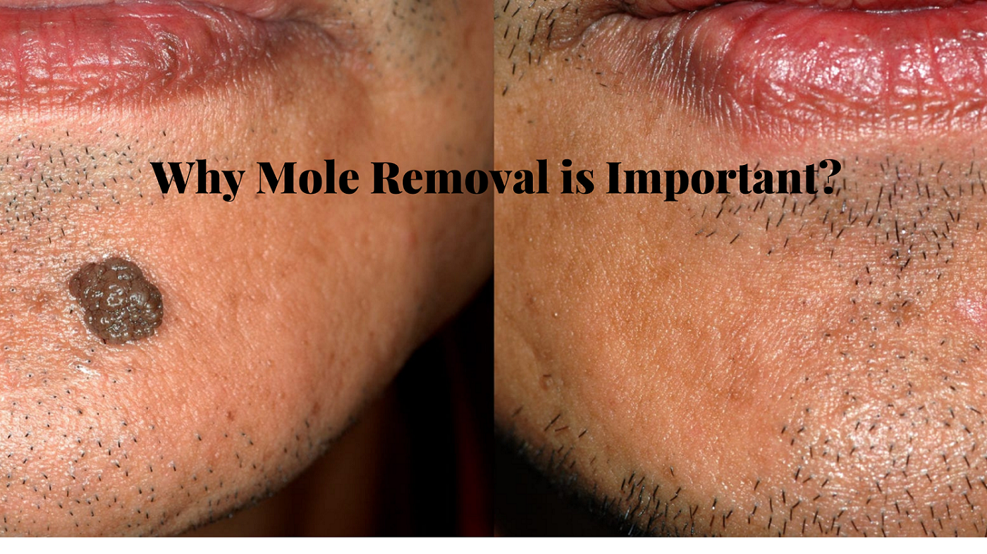 How To Lose Money With Mole Removal