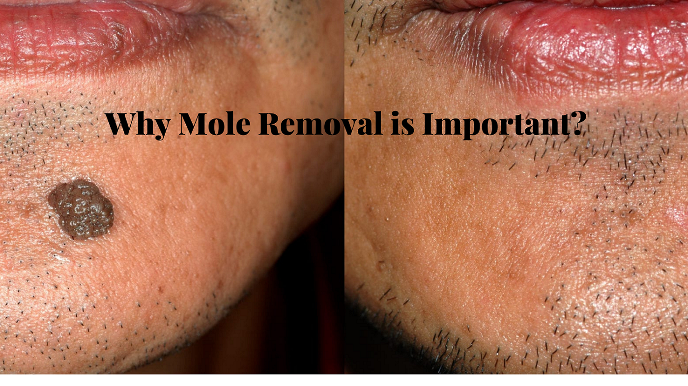 Why I Hate Mole Removal