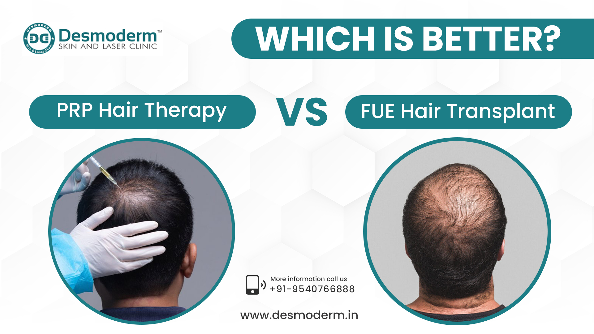 Banner-PRP-Hair-Therapy-vs.-FUE-Hair-Transplant