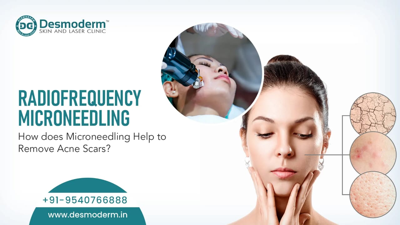 microneedling removes scar