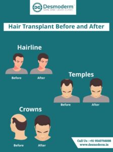 Before and after hair transplant: step-by-step situation