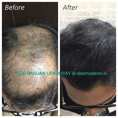 COMMON HAIR LOSS CAUSES  Reniu Skin laser Cosmetolgy  Hair transplant