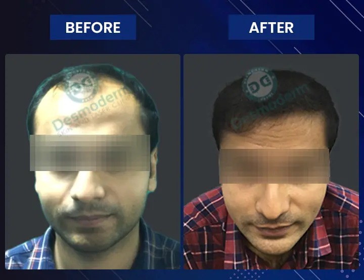 hair transplant