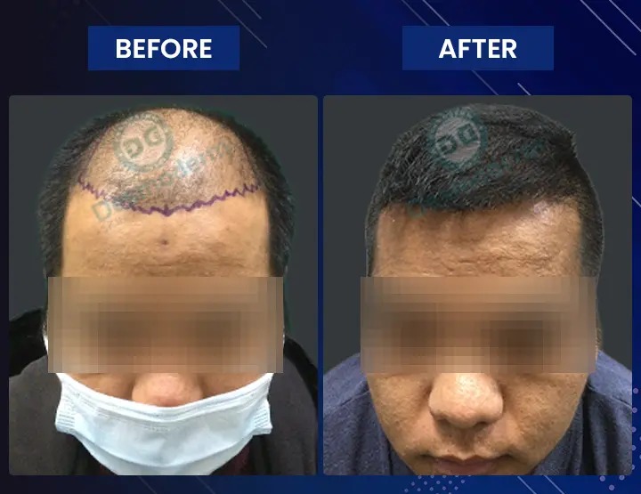 hair transplant