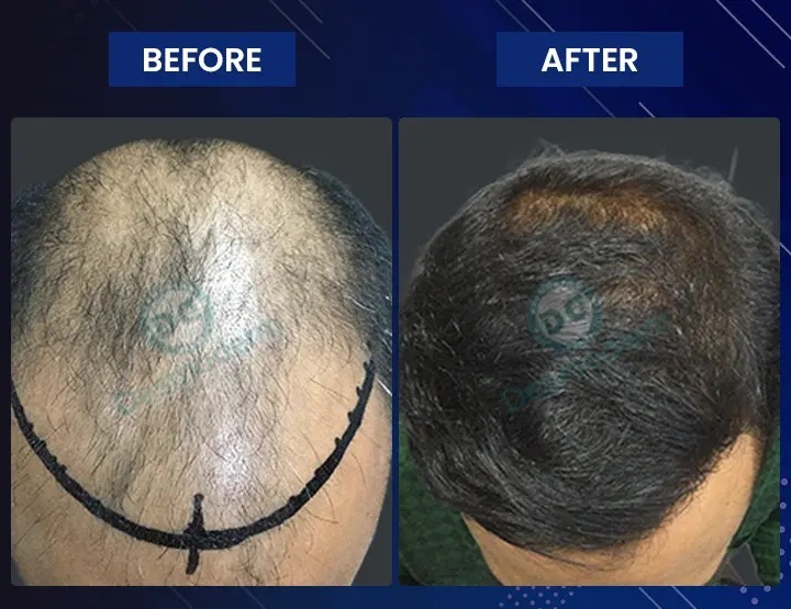 hair transplant