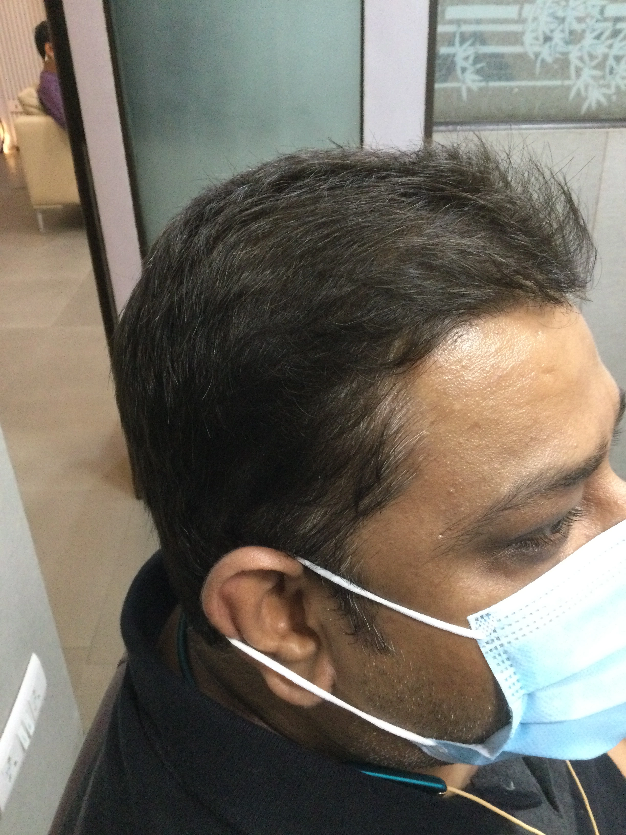 Hair PRP after, Client 2
