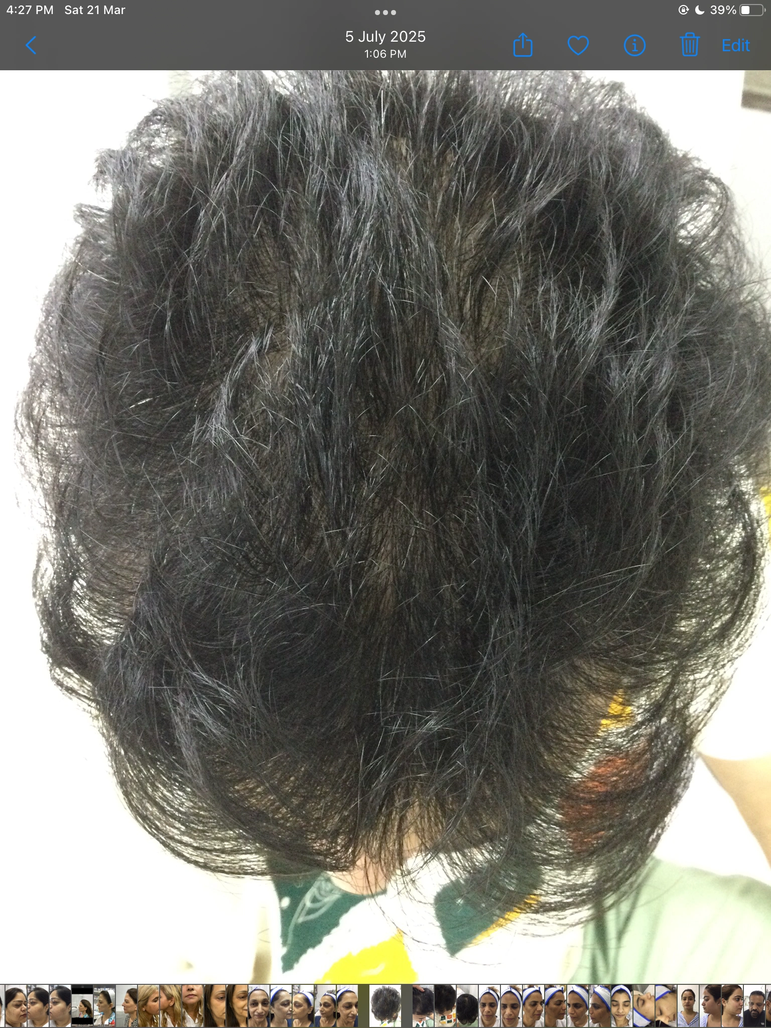Hair PRP before, Client 1