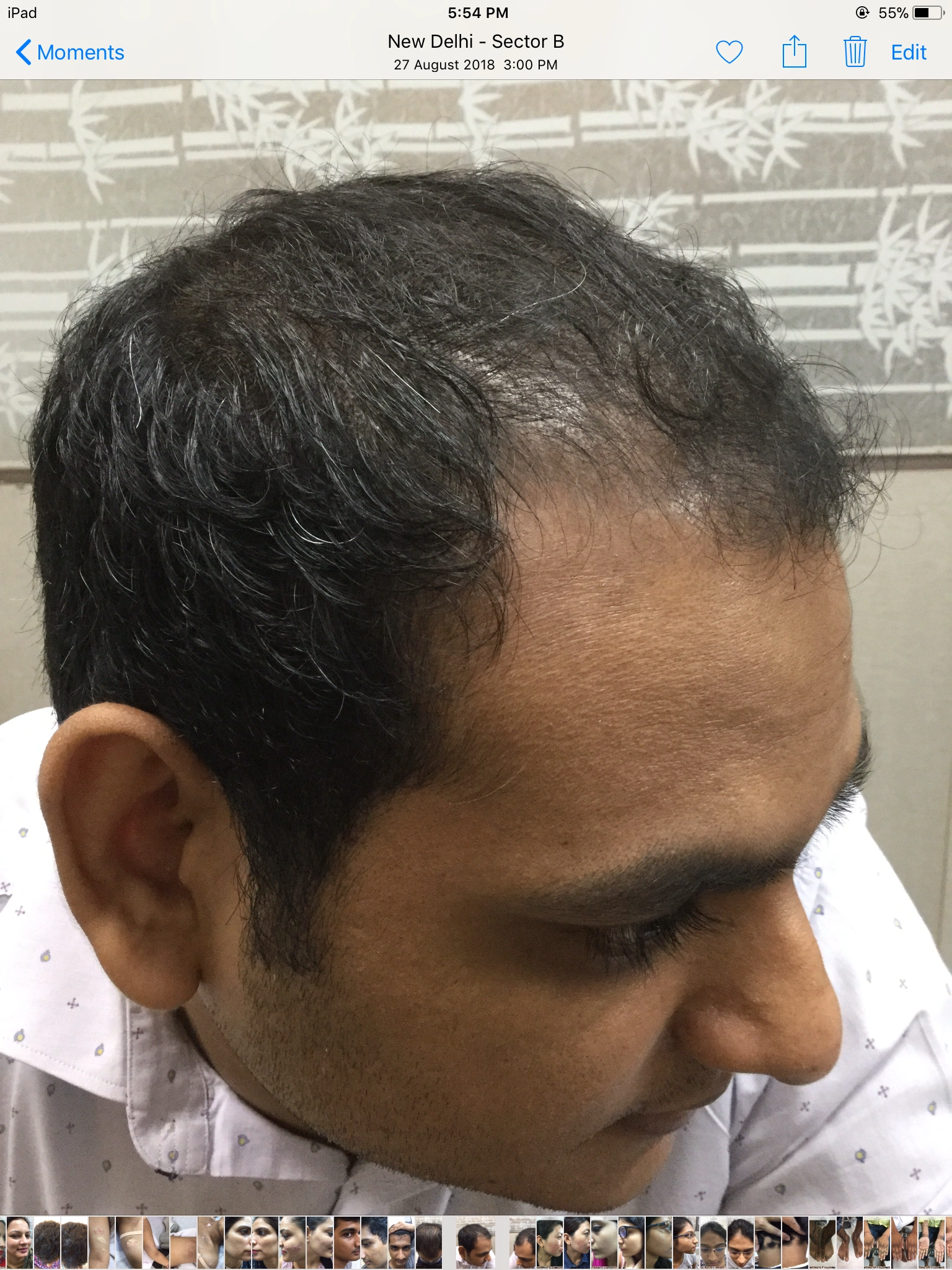 Hair PRP before, Client 3